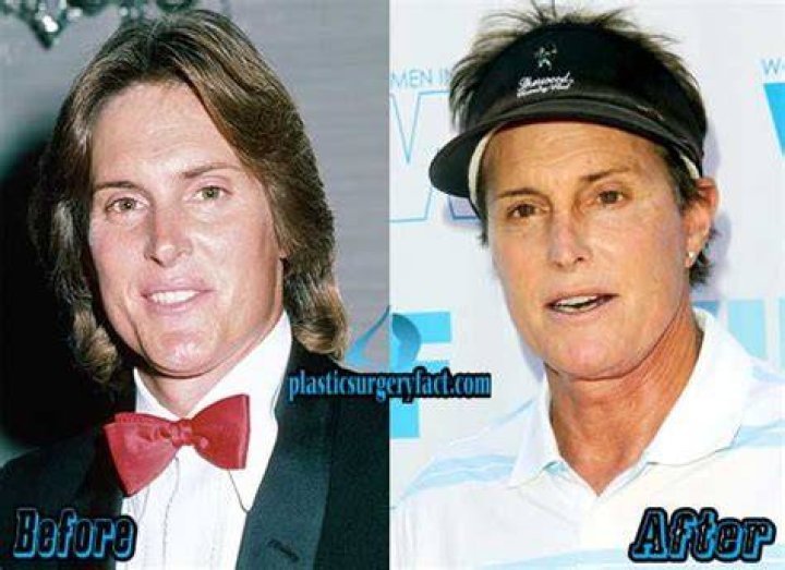 Bruce Jenner Plastic Surgery